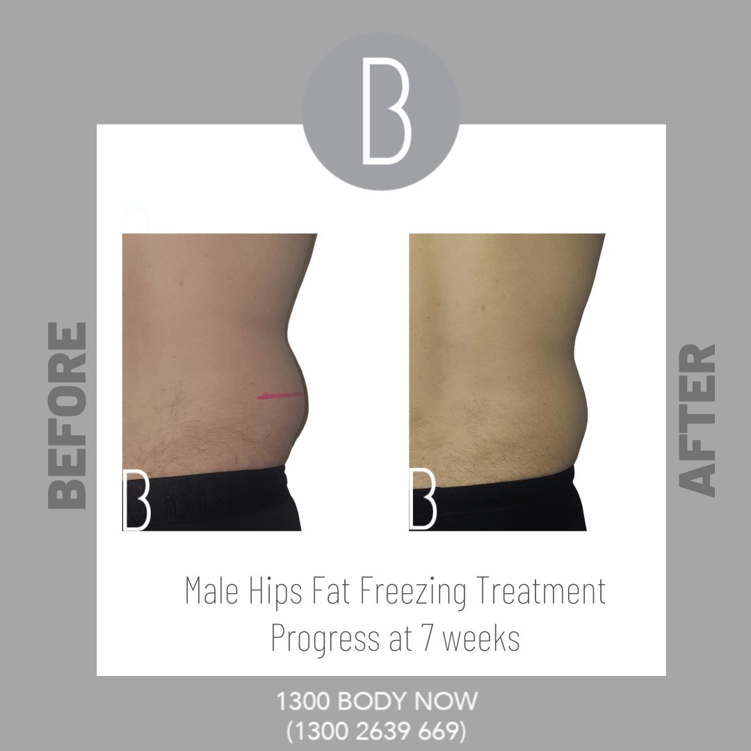 Fat freezing in man waist before and after.jpg
