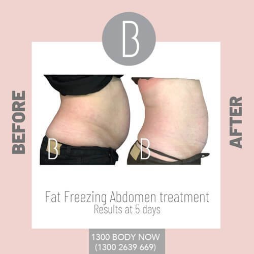 Fat+freezing+results+before+and+after (1).jpg