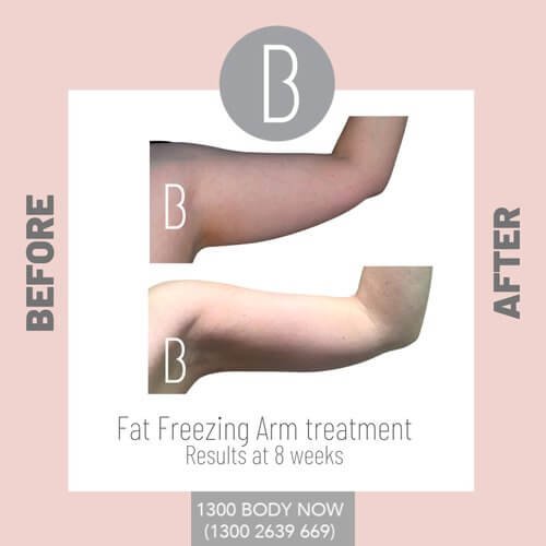Fat+freezing+results+on+arms (1).jpg