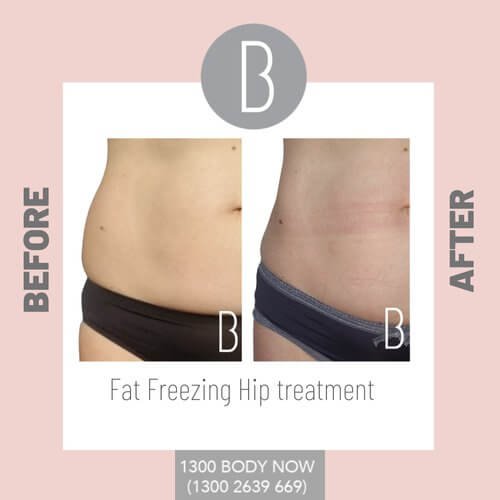 Fat+freezing+results+on+hip (1).jpg