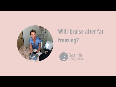 Will I bruise after fat freezing? (also known as Coolsculpting ®)