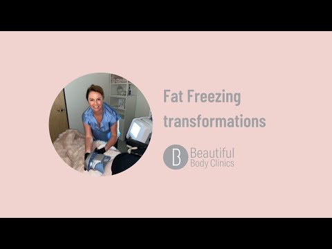 Fat Freezing Transformations with Beautiful Body clinics